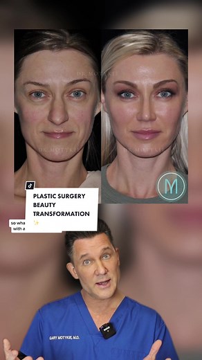 This patient underwent closed rhinoplasty facial fat grafting. I think she looks great! #Rhinoplasty #ClosedRhinoplasty #FacialFatGrafting #FacialRejuvenation #ClosedRhino #ScarlessRhinoplasty #PlasticSurgeonExplains #PlasticSurgeon #PlasticSurgery #PlasticSurgeonTok #BoardCertifiedPlasticSurgeon #NoseJobSurgery #PlasticSurgeonSearch #FacialPlasticSurgery #PlasticSurgeryTransformation #CosmeticSurgery #CosmeticSurgeryTikTok #NoseJobs #NoseJobSurgeon #Rhinoplastik #Rhinoplastie #PlastikSurgery #B