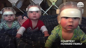 WATCH: These New York babies are the first known case of triplets all born with a rare skull condition. Doctors performed successful surgery on the trio. | Today Health & Wellness