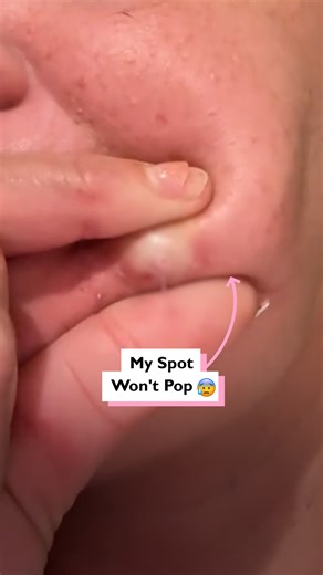 My cyst won't stop growing 😰 | Four Nine