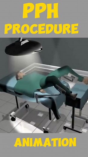 PPH Procedure Animation #pph #procedure #stapled #hemorrhoid #surgery #peyroniesdisease #privatepart #genderchange #Igbt #genderchange #genderchangechallenge #genderchanger #genderafiringsurgeryNIM ATION #genderchangesurgery #genderaffirming #genderaffirmation #genderaffirmationsurgery #genderaffirmationg #maletofemale #femaletomale #transgender #peyronie Medical Media
