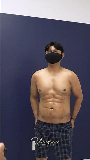 Abdominal Etching by Dr. Fisher #plasticsurgery | Unique Aesthetic Center