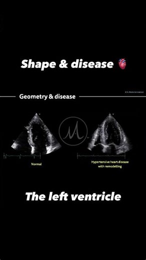 Left ventricular forms & shapes & information about LV #disease #echo #echocardiography #ultrasound