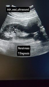 6.6K views · 311 reactions | Renal mass #renalcellcarcinoma #kidneytumor #renaltumor | Ultrasound made easy | Facebook