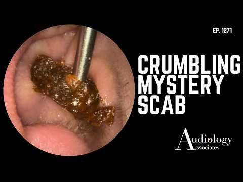 The Crumbly Plug That Just Wouldn't Come Out & A Mysterious Scab Discovery – EP1271