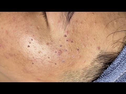Heavy Blackhead & Hidden Acne Removal on Cheeks – Deep Pore Cleansing Treatment | Spa Linh Mun #28