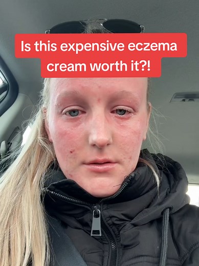 Is a $1000 Eczema Cream Worth it? Topical Options Explained