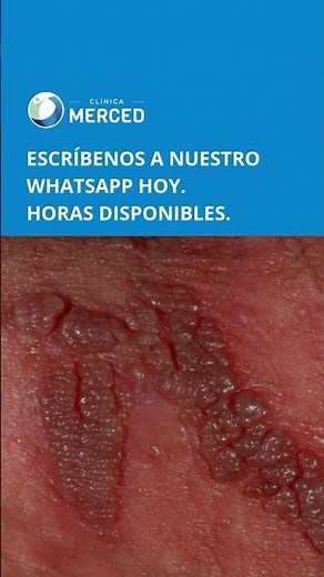 Verrugas genitales: señal de VPH