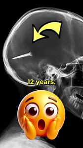 He Lived 12 Years Without Knowing! | Mr Scientific