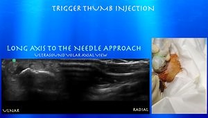 Ultrasound for Trigger Thumb Injection