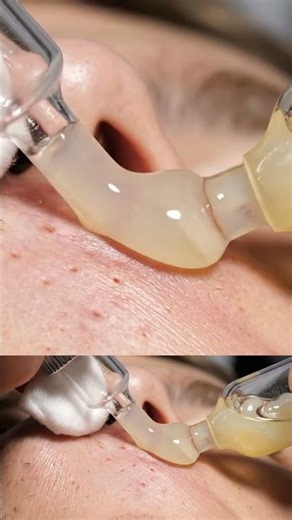 Facial Sebum Pocket Drain — Suction ASMR