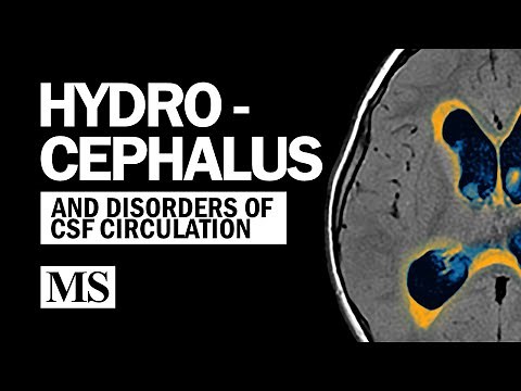 Hydrocephalus And the Disorders of CSF Circulation