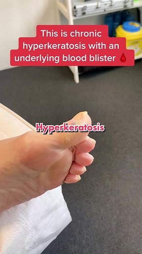 As thick as it gets 😉 #skincare #surgery #feet