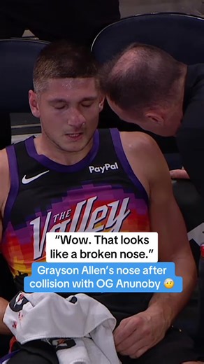 Grayson Allen's Tough Moment: A Broken Nose Update