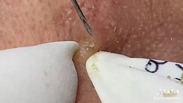 #CapCut #ngvideo_viral_tiktok #pimple #TikTokBeleza #satisfying