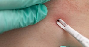 Piqûre de tique : ce symptôme méconnu identifié par la science