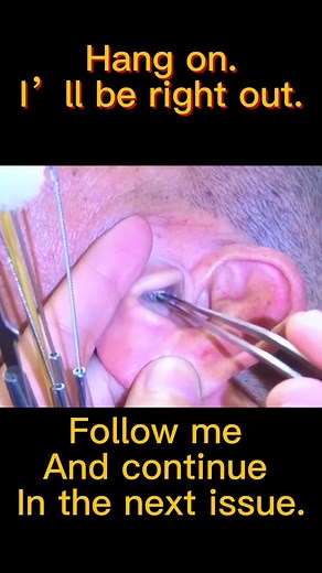 It’s so comfortable after pulling out your #ear .Come and have a try