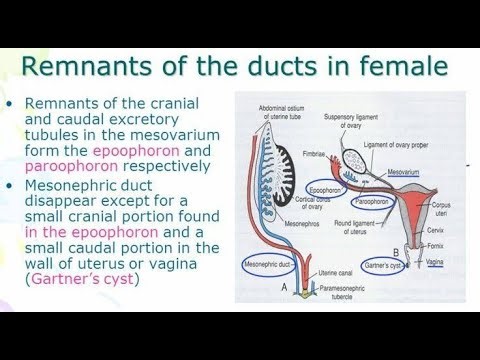 Remnants of the mesonephric duct; Gartner’s duct cysts, Parovarian cysts