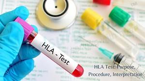 HLA Test : Purpose, Procedure, Interpretation | Medsurge India