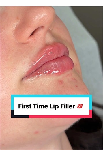 First time getting lip filler… and instantly obsessed! 😍 Shay used 1 syringe of Juvederm Ultra for those perfectly full, hydrated lips. Results shown are immediately post-injection! #lipfiller #orlandolipfiller #injectables #vadoplasticsurgery **Educational content only. Treatments have associated risks. Consult required to determine candidacy. Results vary.