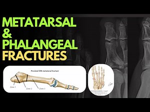 Metatarsal and Phalangeal Fractures | Zones, Imaging & Treatment Explained