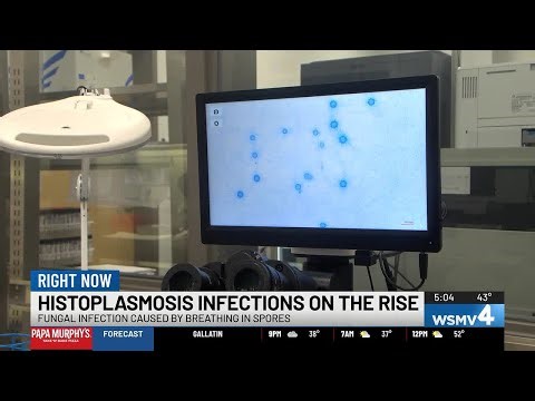 Nashville boy living with rare complication from histoplasmosis