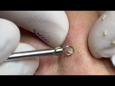 Deep Blackhead Extraction on Cheeks | Super Clean Pores