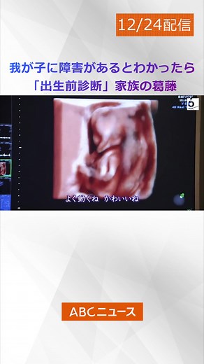 生まれる前のわが子に障害があるとわかったら、#妊婦 やその家族はどのように悩み、どのような決断を下すのだろうか。#出生前診断 を受けて#胎児 の異常を知った家族の葛藤の日々を追いました。完全版は#Youtube 「#ABCテレビニュース 」で。