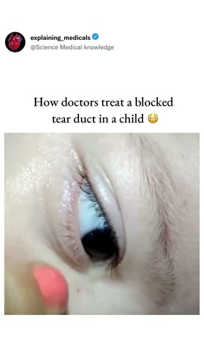 How doctors treat a blocked tear duct in a child 😳#trending #doctorlife #viral #shortvideo #nurse