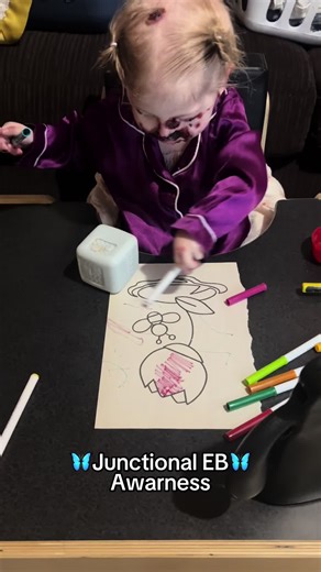 Tova's Colorful Journey with Junctional Epidermolysis Bullosa