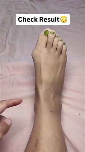 How to Correct Toe Deformity at Home ( # 2115 ) 1️⃣ Adjustable Foot Care Big Toe Straightener