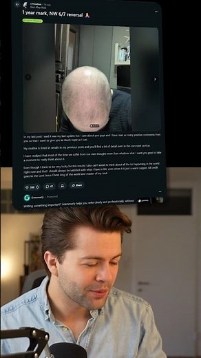 Hair regrowth success using Finasteride, Minoxidil and Microneedling