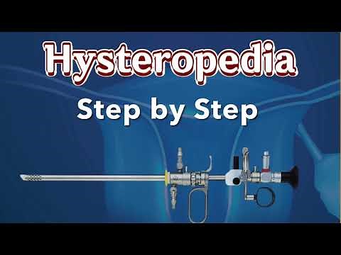 Step by step hysteroscopic myoma resection by Osama Shawki