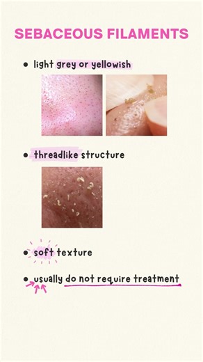 sebaceous filaments are NOT blackheads!