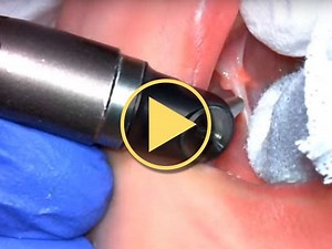 Infant Laser Frenectomy (Tongue-Tie Released) - Video