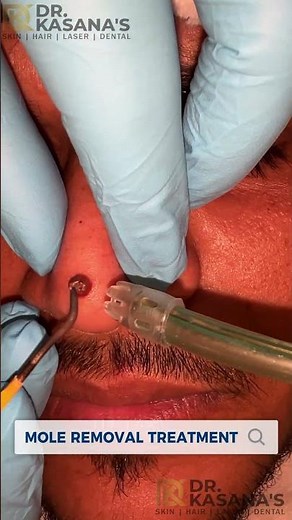 1 Genius Ways to Remove Moles Without Surgery Dr.Lalit Kasana's
