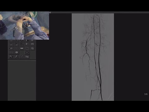 Treatment of CLI Patient with SFA CTO and Non-Healing Ulcer