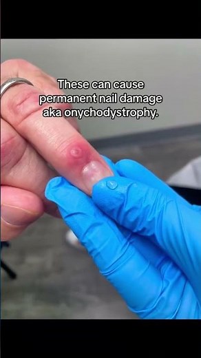 What is a Digital Mucous Cyst? Derm Explination! ✨🖐🏼 #NailCare #Cyst