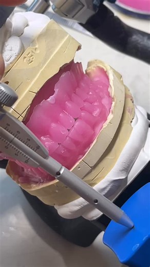 Andrea Korndörfer | Dentallabor on Instagram: "Never throw away the old dentures. They are a clinical document. They show how the patient lived, spoke, chewed. When we have existing dentures, we use them. We take a functional impression inside the old base and lock in the proven jaw relation. Digital is great. But functional shaping of all those moving soft tissues? Not reliably possible. Yet. So we duplicate the dentures in wax. Same bite. Same setup. A fresh start without losing what already w