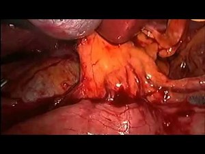Laparoscopic Management Of Bleeding During Anatomical Liver Resection  • Video • MEDtube.net