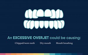 931K views · 56 reactions | Excessive overjet is when upper teeth protrude outward over the bottom teeth which can cause health issues such as difficulty chewing, dry mouth, and chipped teeth. Our doctors and Motto Aligners can help. | Aspen Dental | Facebook