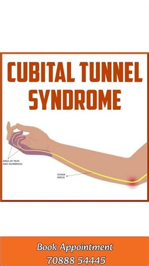 “Cubital Tunnel Syndrome — The Hidden Cause Behind Numb Fingers & Hand Weakness!