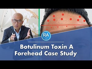 Botox Forehead on Man // Botulinum Toxin A Injections Case Study