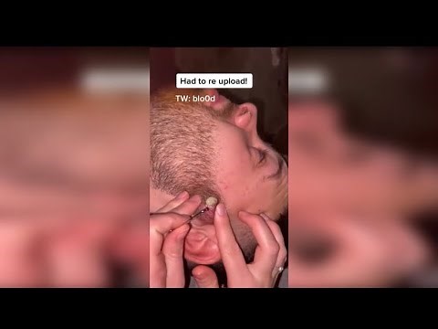 Best huge cyst and pimple pop compilation