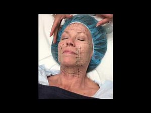 Thermage Procedure