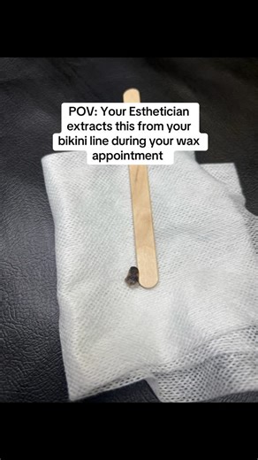 Tiffany | KC Esthetician | MUA + Educator on Instagram: "Look what I extracted today during a Brazilian wax — a keratin plug! But what exactly is that? Let me explain: A keratin plug is a buildup of dead skin cells, oil, and sometimes a trapped hair. It forms when the hair follicle gets blocked, which can lead to ingrown hairs, inflammation, or even small bumps on the skin. Where do they show up most? High-friction areas like the bikini line, underarms, or anywhere hair is frequently removed. Ho