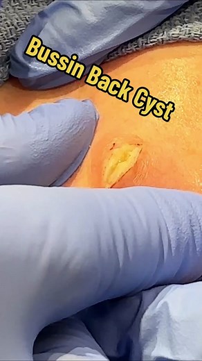 Bussin back cyst #excision #cystpopping