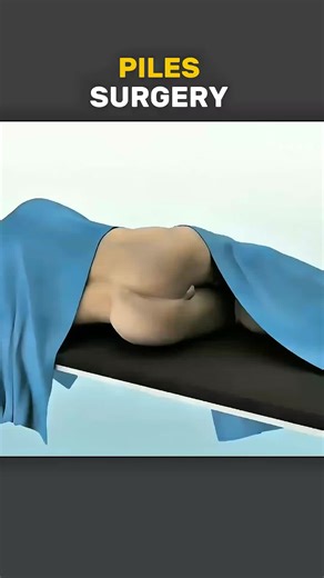 Piles Surgery Explained: Medical 3D Animations