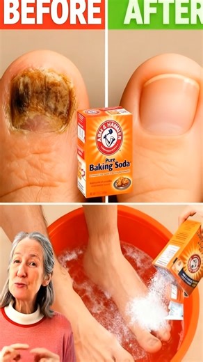 58K views · 138 reactions | How to Use Baking Soda to Treat Nail Fungus  | Clean Life Hacks | Facebook
