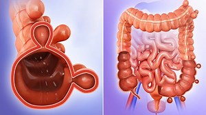 Diverticular disease and diverticulitis can be incredibly painful, but you don't have to live with the discomfort. In this video, we share 5 home remedies for diverticular disease that have been proven to provide fast relief. Whether you're dealing with mild symptoms or more severe issues, these natural remedies can help reduce inflammation and promote healing in the digestive tract. Learn how simple lifestyle changes and natural treatments can support your gut health and help you manage diverti