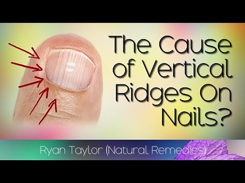 Do You Have Vertical Ridges On Your Nails? (Cause)